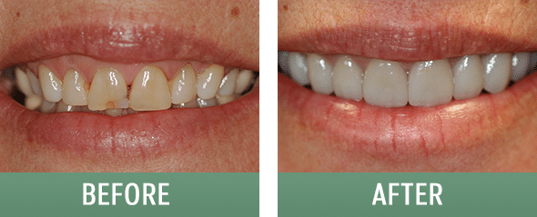 Before and after photos of Sugar House Dentist patient in Salt Lake City