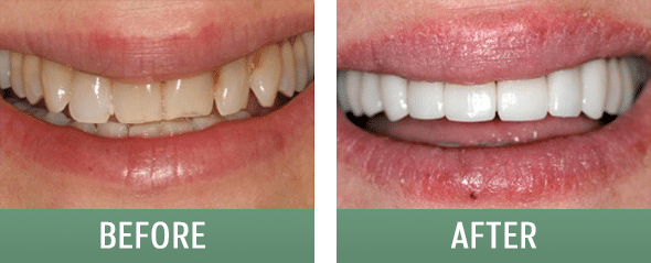 Before and after visiting the cosmetic dentist in Sugar House