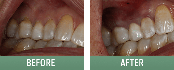 Dentist patient before and after gum rejuvenation