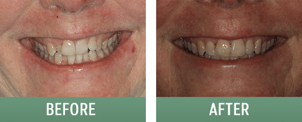 Before and after Invisalign in Salt Lake City at The Sugarhouse Dentist