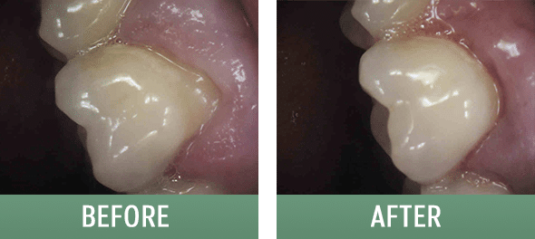 Pinhole gum rejuvenation treatment at the Sugarhouse Dentist