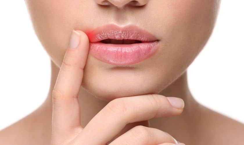 Common Canker Sore Triggers To Avoid