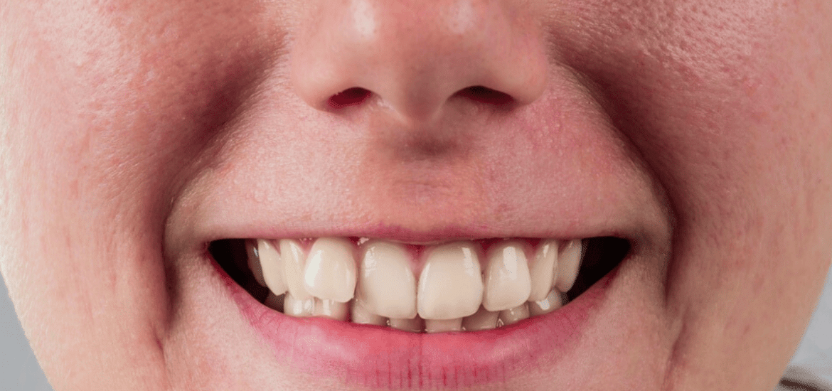 Malocclusion can cause headaches
