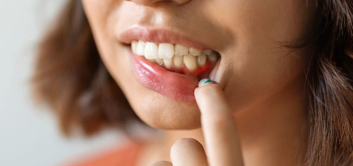 five serious signs of gum disease