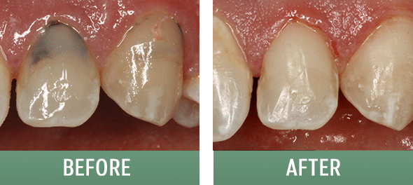 Composite dental restorations. before and after photos