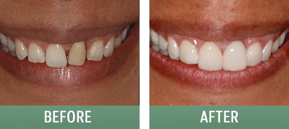 Dental implants with dental veneers before and after photo