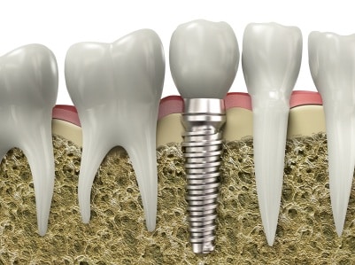 Dental implants compared to dental bridges in Sugarhouse