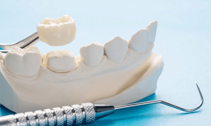 Dental Crowns