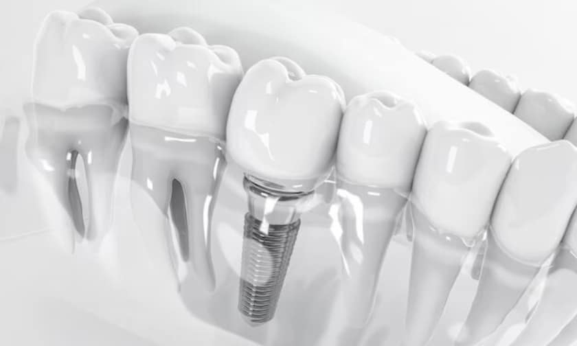 Dental Implants Salt Lake City