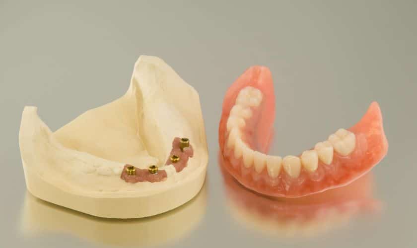 Dental Implants Vs. Dentures