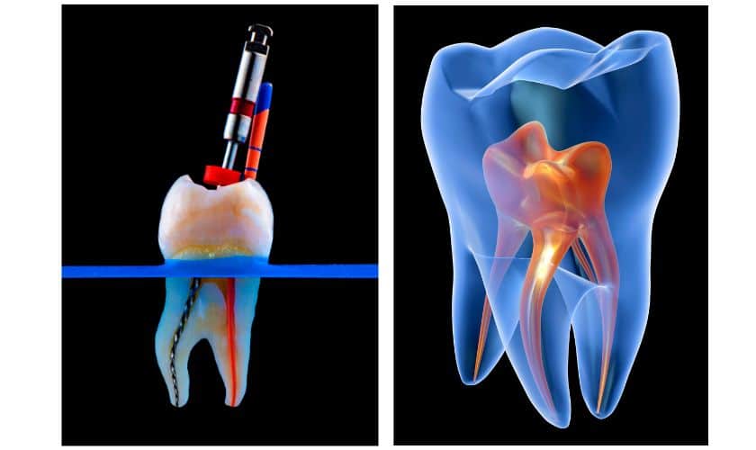 evolution of Root canal