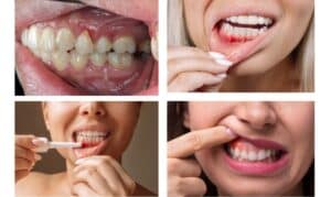 four different photos of gum disease