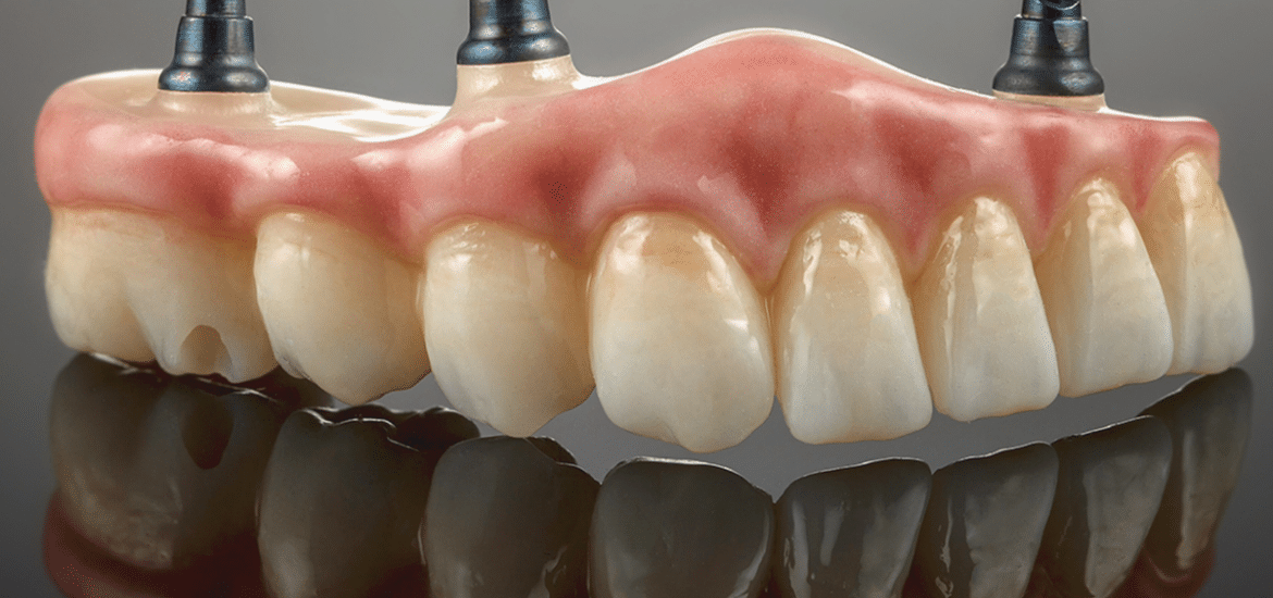 Implant-Supported Dentures