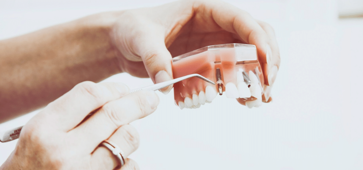 dental implant