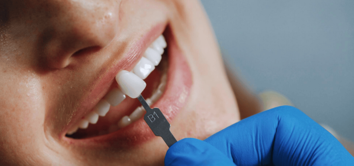 The Best Veneer Care Routine for 2025