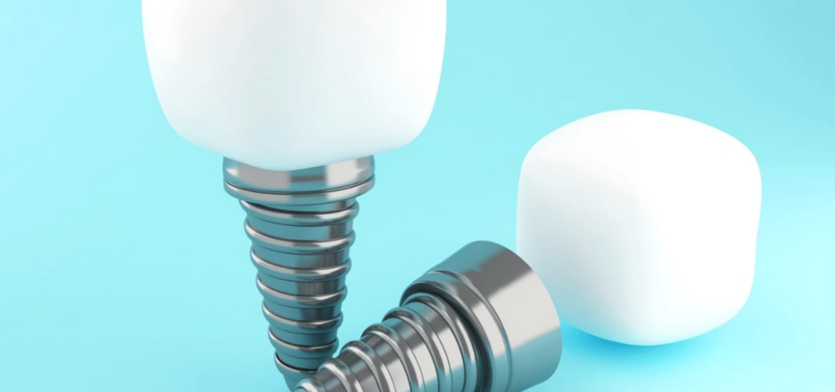 What Are Mini Dental Implants?