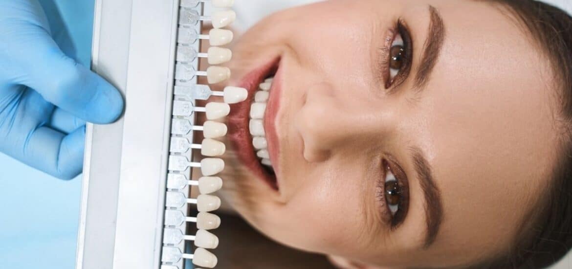 Women smiling while having dental veneers