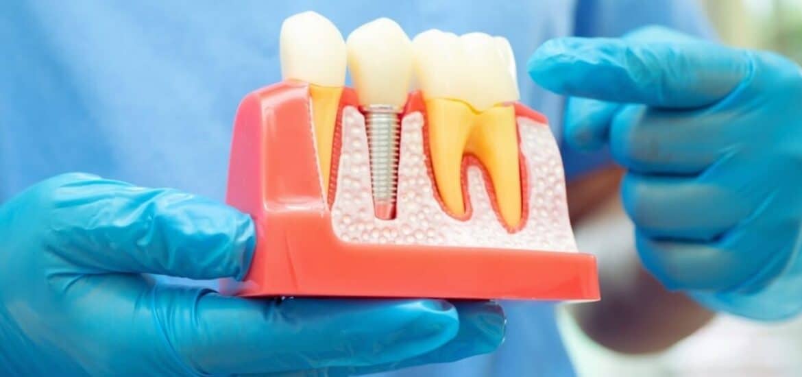 Dental Implants for All Life Stages