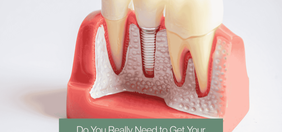 Blog cover with Dental implant tooth model and text overlay
