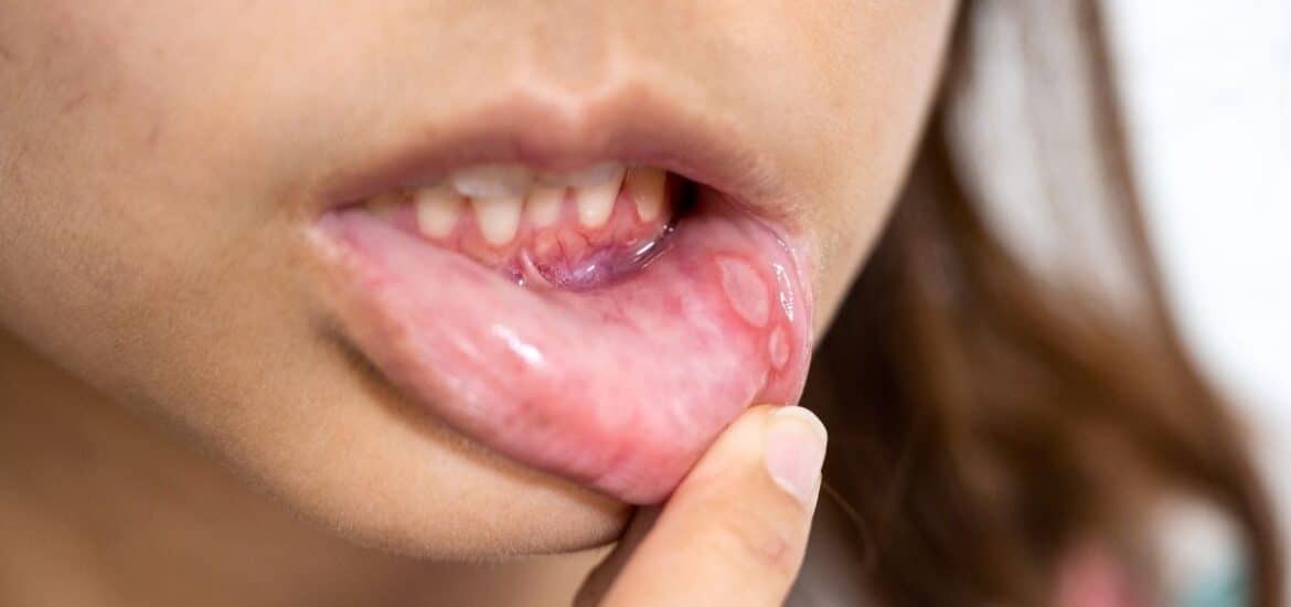 when mouth ulcer can be serious