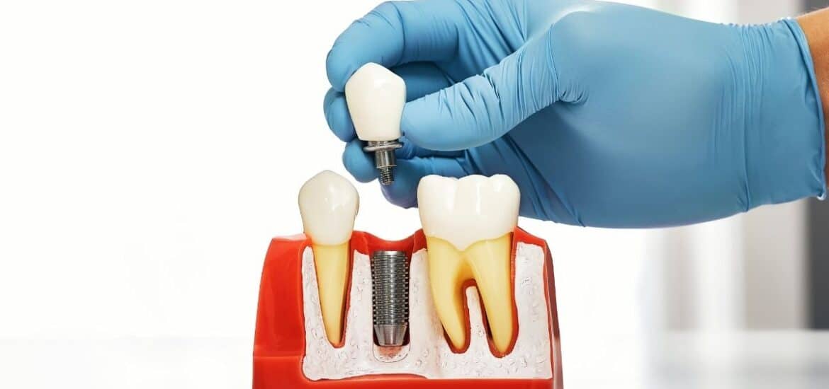 Are Dental Implants Possible Years After Losing Teeth