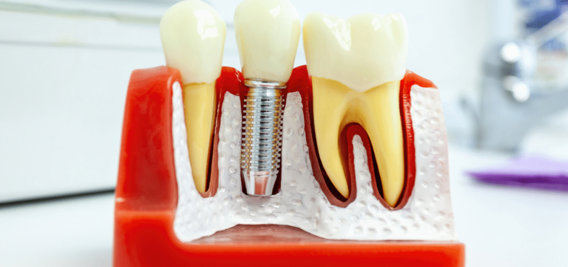 Hidden Risks of Waiting Too Long for Dental Implants