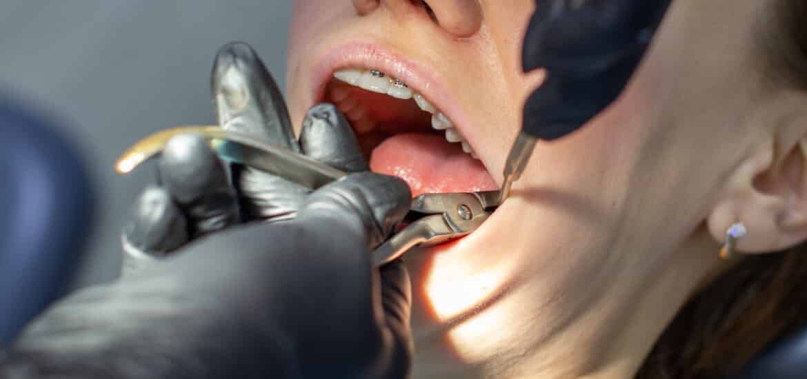 5 Signs Your Teeth Need a Dentist—Even Without Pain